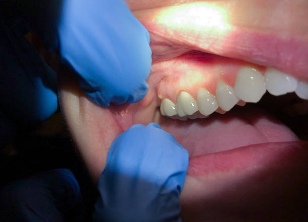 Best Emergency Tooth Extraction in Greenfield, MO